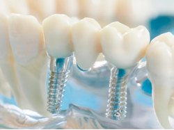 Услуги по имплантации зубов